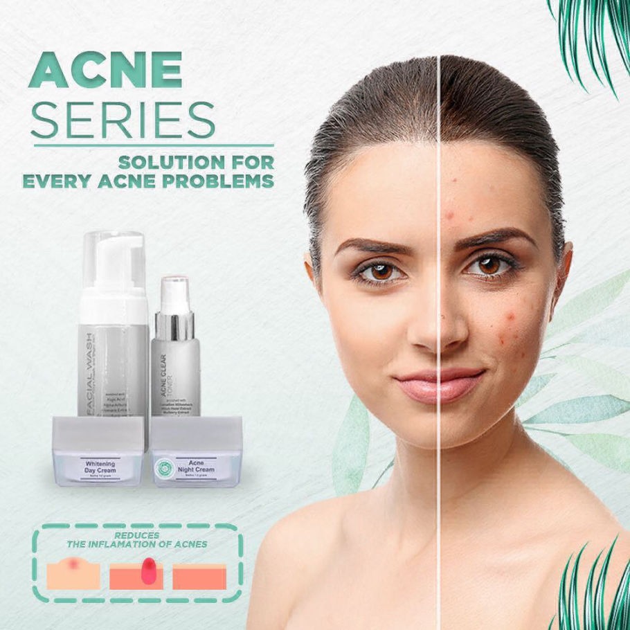 Menghilangkan Jerawat Dengan Produk MS Glow Acne Series. Bisa? Menghilangkan Jerawat Dengan Produk MS Glow Acne Series. Bisa?