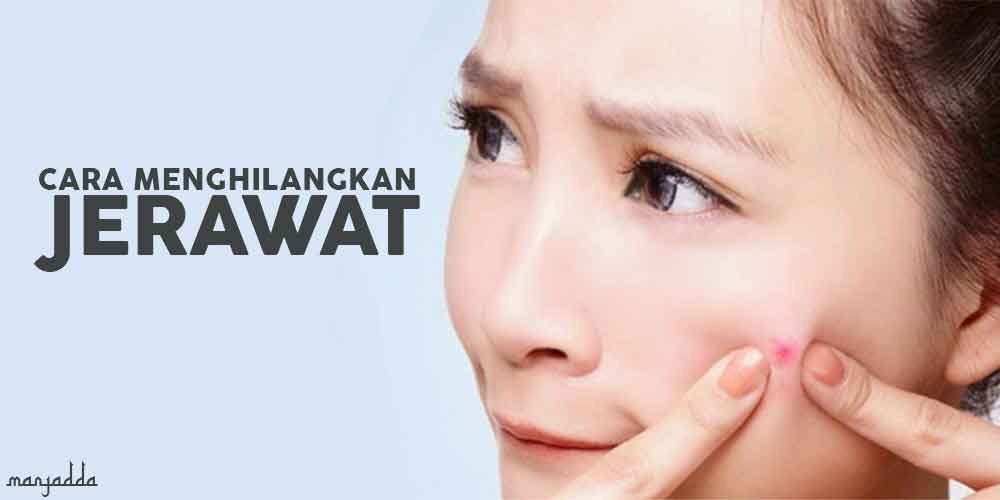 Kenapa Jerawat Susah Sembuh? Mungkin Ini Penyebabnya Kenapa Jerawat Susah Sembuh? Mungkin Ini Penyebabnya