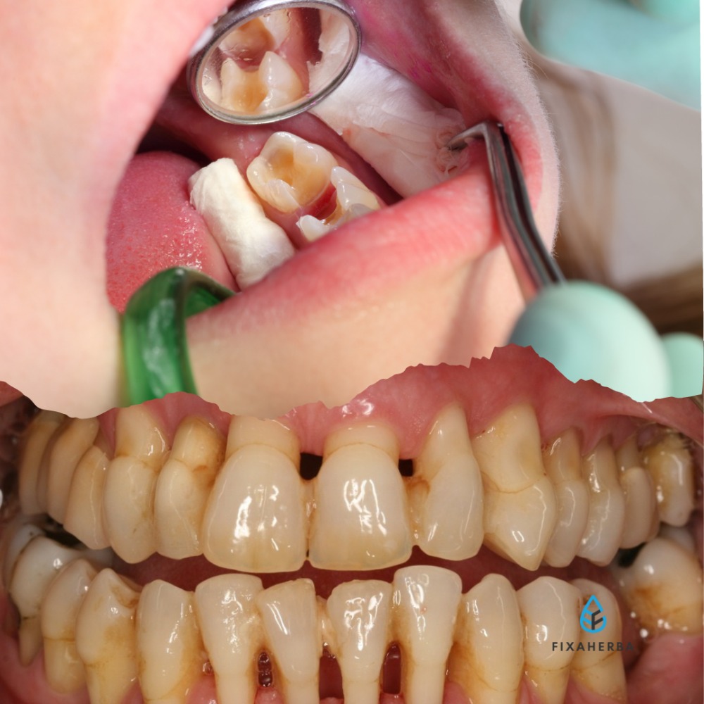 karies gigi & penyakit gusi