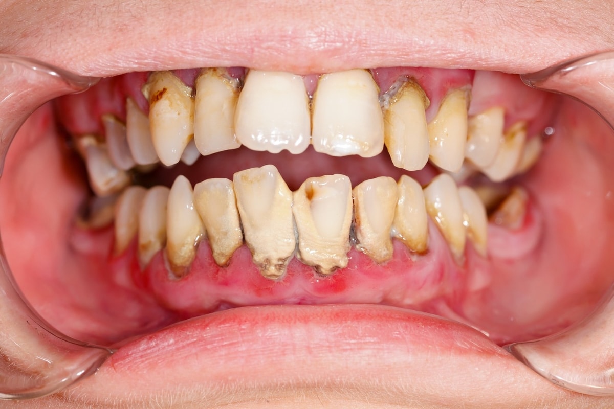 periodontitis