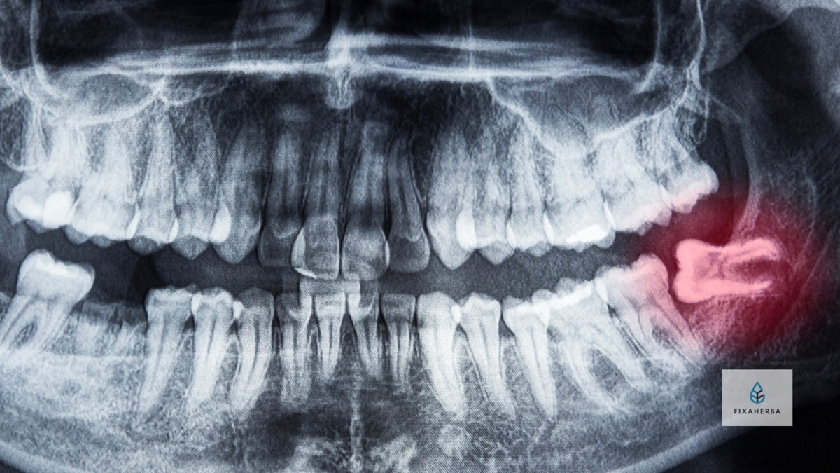 wisdom teeth on x-ray