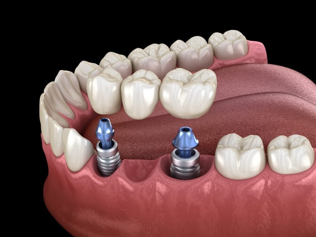 Implant-supported dental bridge