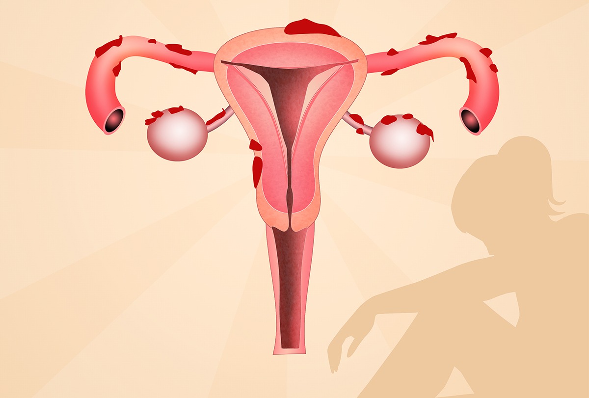 Penting Bagi Wanita : Kenali Bahaya Endometriosis Dan Mengambil Tindakan Yang Tepat