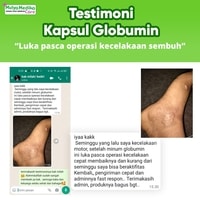 TESTIMONI KAPSUL KUTUK GLOBUMIN - 7X Mempercepat Penyembuhan Luka Pasca Berbagai Operasi
