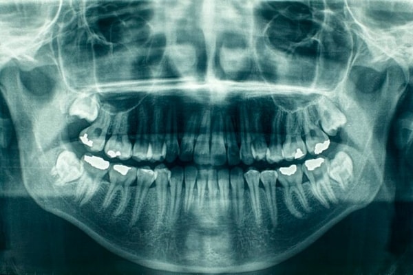 panoramic x-ray