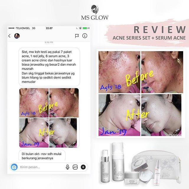 Review Acne MS Glow