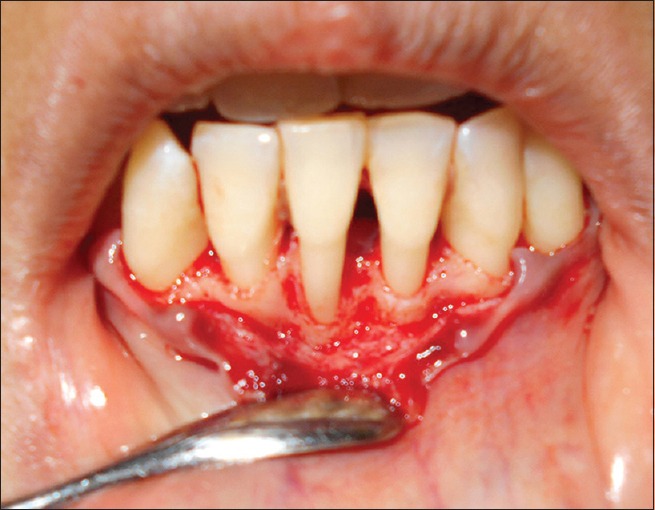 Kenali Bahaya Gingivitis Dan Periodontitis