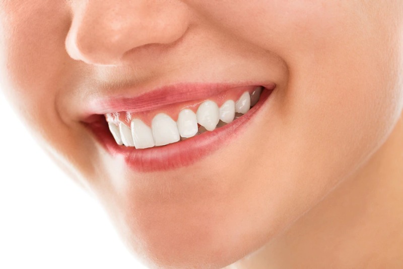 Tertarik Dengan Bleaching Gigi?? Yuk Kenali Dulu Manfaat dan Efeknya Buat Gigi!