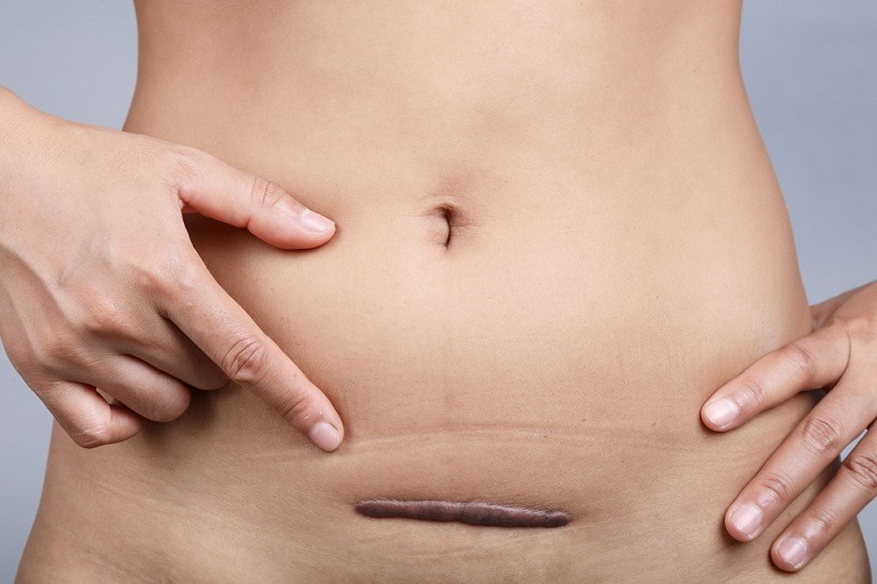 Keloid: luka yang terjadi pada bekas luka operasi caesar