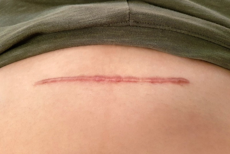Keloid yang terjadi saat pasca luka operasi caesar